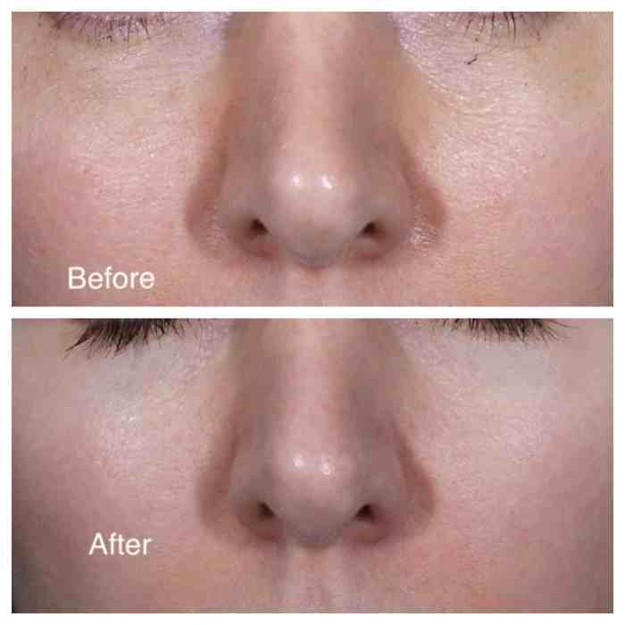 Microdermabrasion benefits facial microderm after before infusion pores skin cost cheap